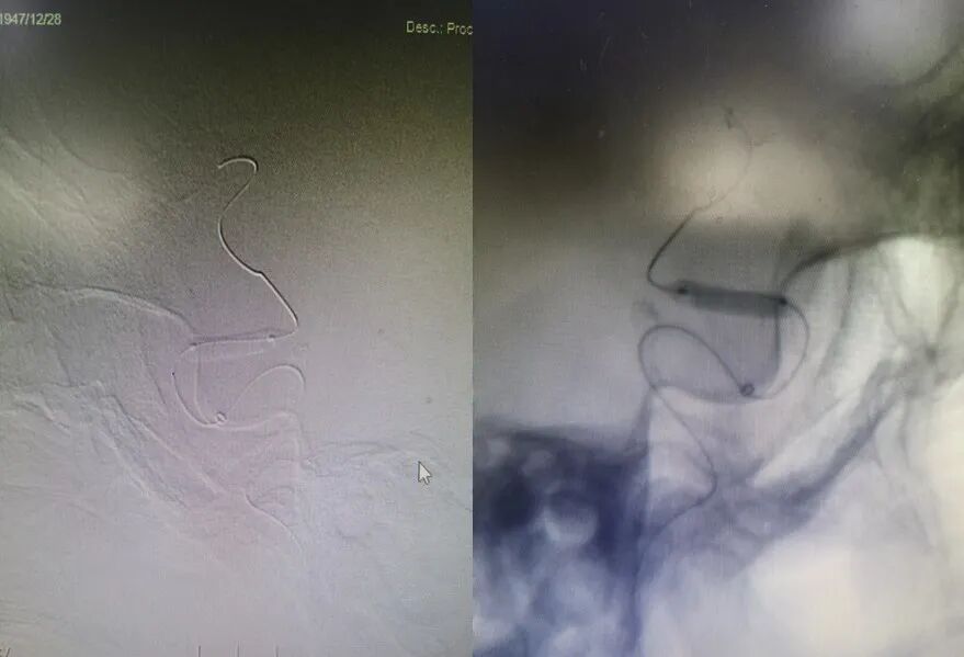 导丝怎么扩【载药时代 球扩天下】NOVA DES®颅内药物洗脱支架在症状性颅内动脉狭窄中的应用—烟台鲁东医院使用体会二例！_https://www.jmylbn.com_新闻资讯_第21张