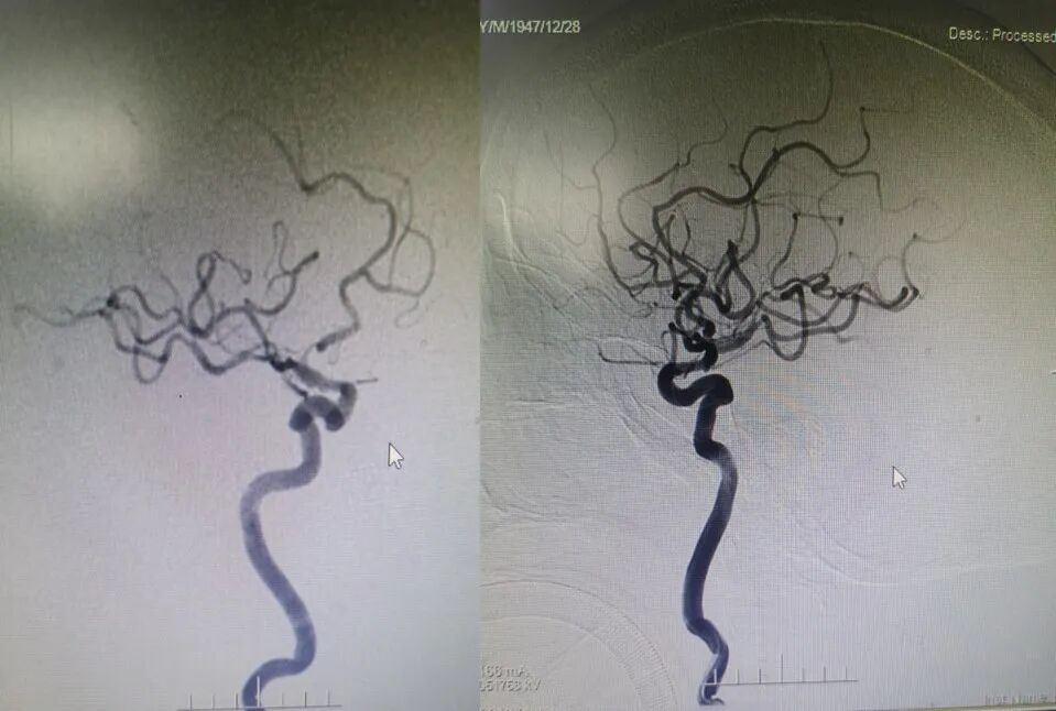 导丝怎么扩【载药时代 球扩天下】NOVA DES®颅内药物洗脱支架在症状性颅内动脉狭窄中的应用—烟台鲁东医院使用体会二例！_https://www.jmylbn.com_新闻资讯_第23张