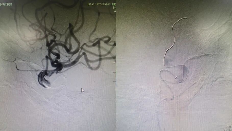 导丝怎么扩【载药时代 球扩天下】NOVA DES®颅内药物洗脱支架在症状性颅内动脉狭窄中的应用—烟台鲁东医院使用体会二例！_https://www.jmylbn.com_新闻资讯_第20张