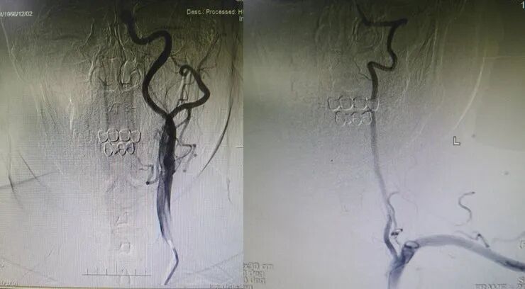 导丝怎么扩【载药时代 球扩天下】NOVA DES®颅内药物洗脱支架在症状性颅内动脉狭窄中的应用—烟台鲁东医院使用体会二例！_https://www.jmylbn.com_新闻资讯_第5张