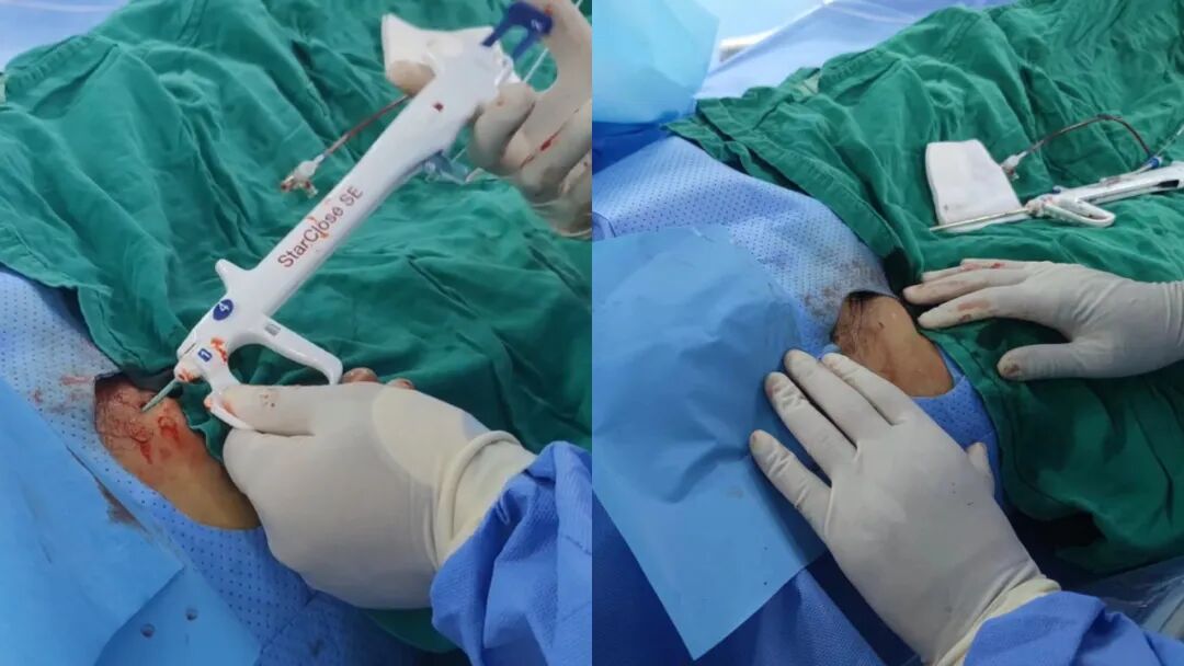 血管闭合系统是什么缝闭生辉 ｜ 血管闭合器在颅内动脉取栓术中的应用_https://www.jmylbn.com_新闻资讯_第16张