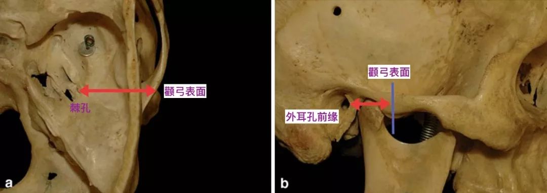 2008)研究了棘孔在體表的相對位置,從棘孔垂直於顳骨鱗部到顴弓外表面