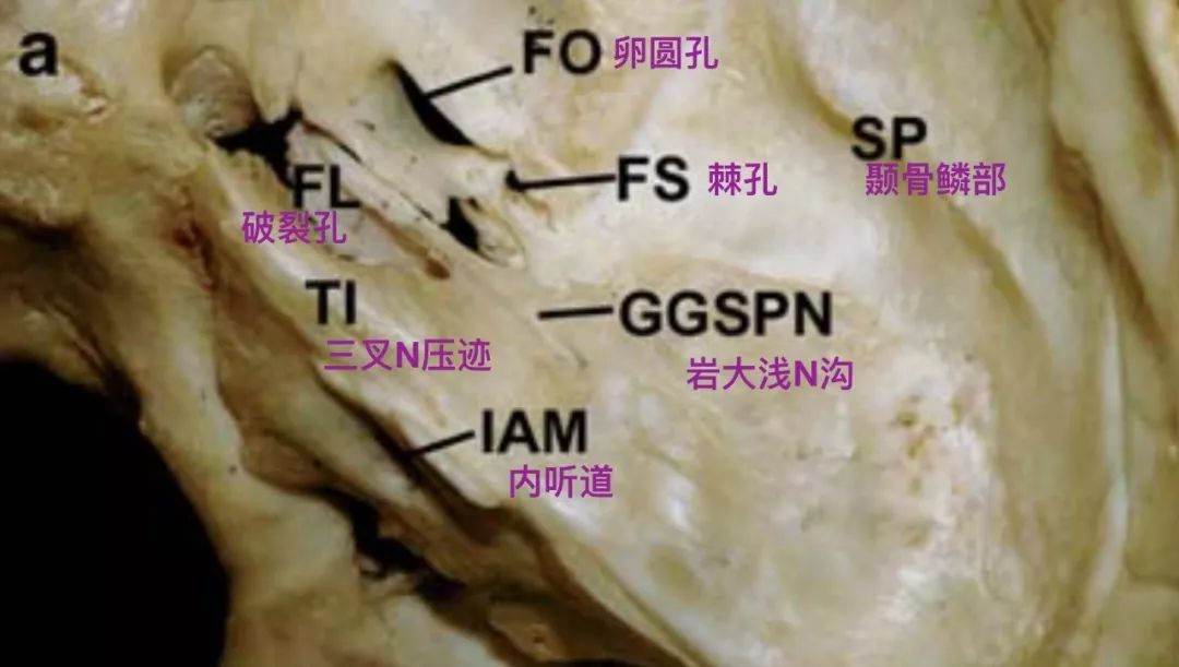 脑膜中动脉额支骨沟从棘孔处延伸到蝶骨嵴(liu 2001)
