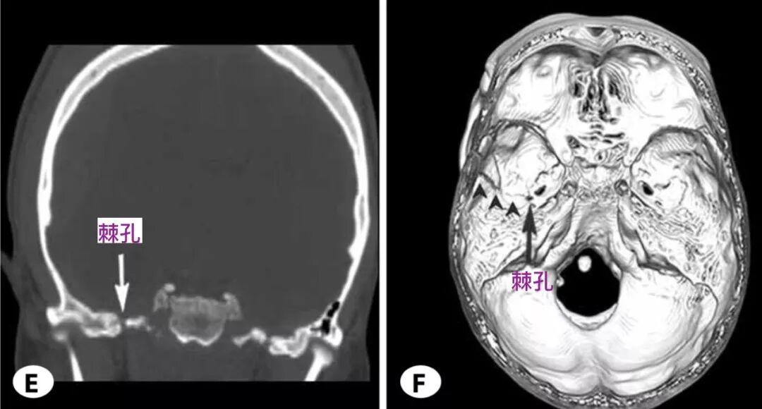 脑血管解剖学习笔记第2期棘孔的解剖