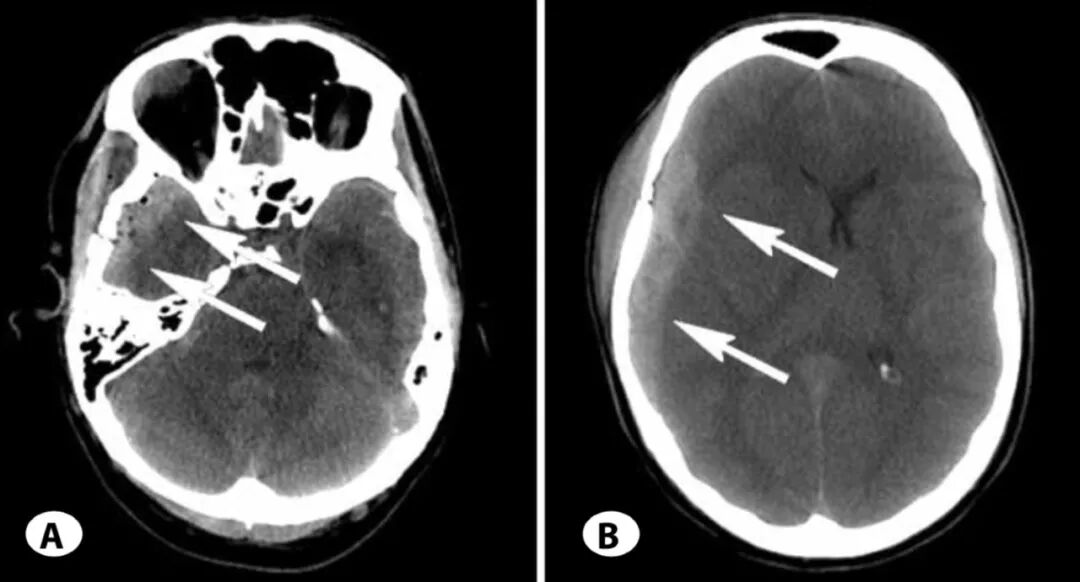 脑血管解剖学习笔记第2期棘孔的解剖
