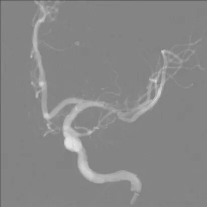 导丝怎么扩【载药时代 球扩天下】NOVA DES®颅内药物球扩支架在大脑中动脉重度狭窄中的应用——济南市第四人民医院使用体会一例！_https://www.jmylbn.com_新闻资讯_第9张