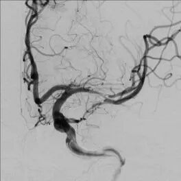 导丝怎么扩【载药时代 球扩天下】NOVA DES®颅内药物球扩支架在大脑中动脉重度狭窄中的应用——济南市第四人民医院使用体会一例！_https://www.jmylbn.com_新闻资讯_第11张