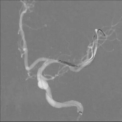 导丝怎么扩【载药时代 球扩天下】NOVA DES®颅内药物球扩支架在大脑中动脉重度狭窄中的应用——济南市第四人民医院使用体会一例！_https://www.jmylbn.com_新闻资讯_第10张