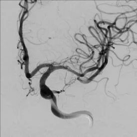 导丝怎么扩【载药时代 球扩天下】NOVA DES®颅内药物球扩支架在大脑中动脉重度狭窄中的应用——济南市第四人民医院使用体会一例！_https://www.jmylbn.com_新闻资讯_第12张