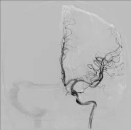 导丝怎么扩【载药时代 球扩天下】NOVA DES®颅内药物球扩支架在大脑中动脉重度狭窄中的应用——济南市第四人民医院使用体会一例！_https://www.jmylbn.com_新闻资讯_第13张