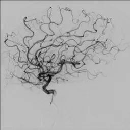 导丝怎么扩【载药时代 球扩天下】NOVA DES®颅内药物球扩支架在大脑中动脉重度狭窄中的应用——济南市第四人民医院使用体会一例！_https://www.jmylbn.com_新闻资讯_第14张