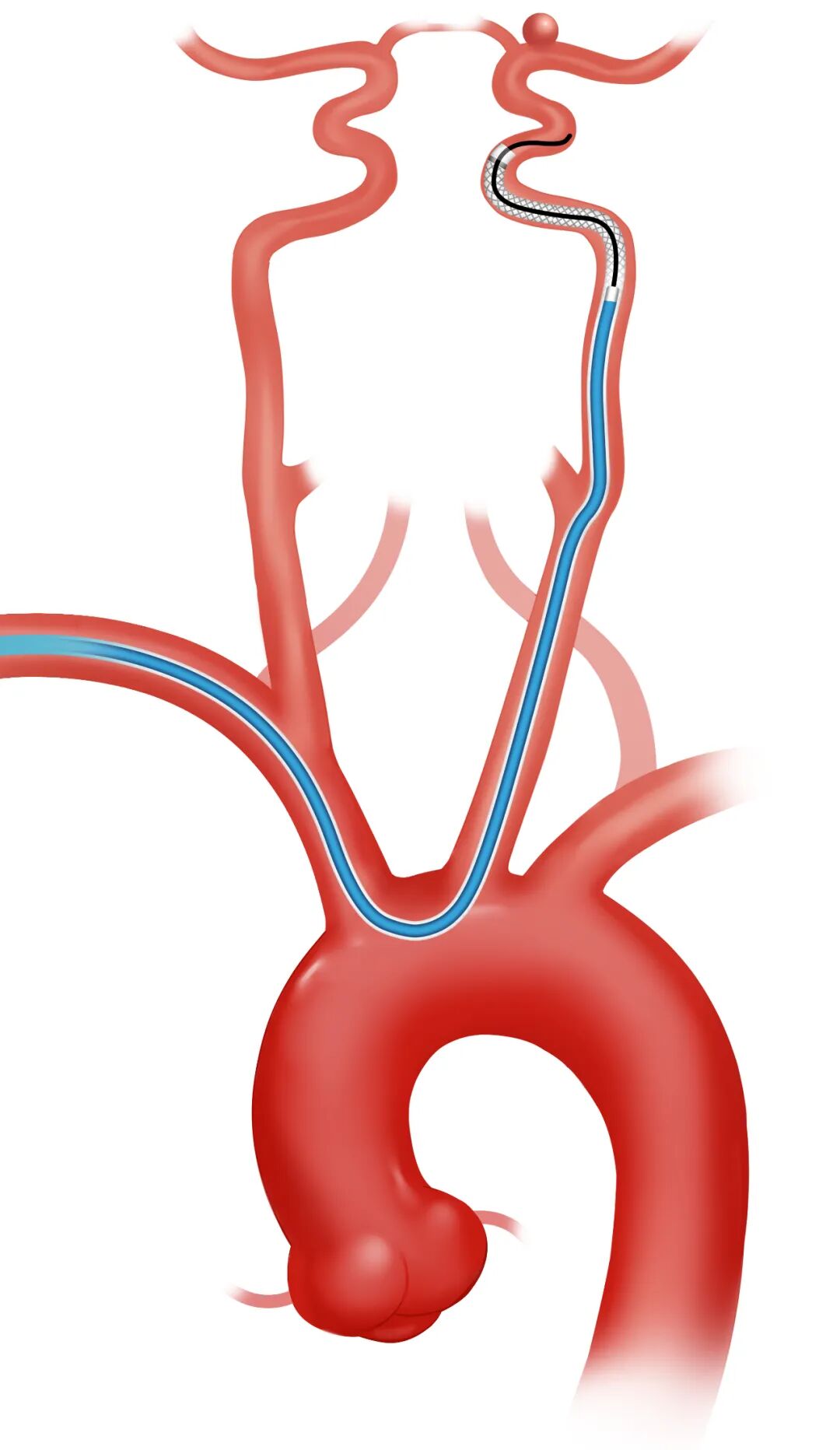 泥鳅导丝怎么用因桡而生 与众不同丨COATS桡动脉专用通路导引系统同轴技术详解_https://www.jmylbn.com_新闻资讯_第16张
