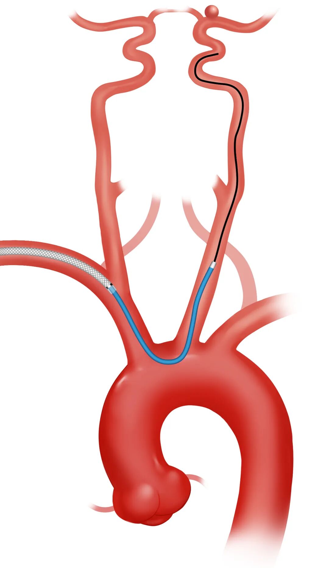 泥鳅导丝怎么用因桡而生 与众不同丨COATS桡动脉专用通路导引系统同轴技术详解_https://www.jmylbn.com_新闻资讯_第14张