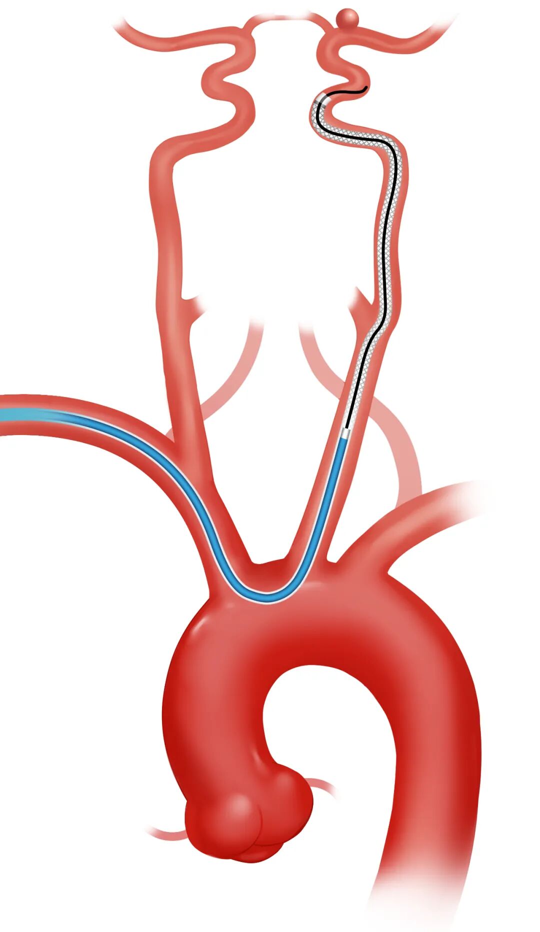 泥鳅导丝怎么用因桡而生 与众不同丨COATS桡动脉专用通路导引系统同轴技术详解_https://www.jmylbn.com_新闻资讯_第15张