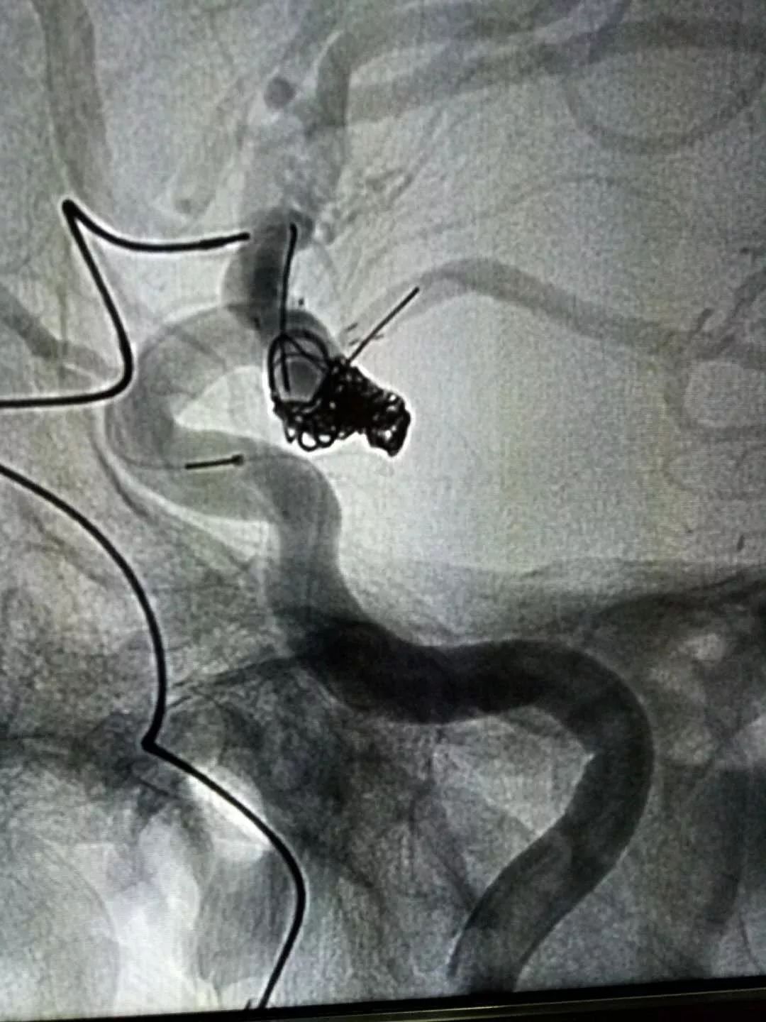 颈动脉瘤支架图片