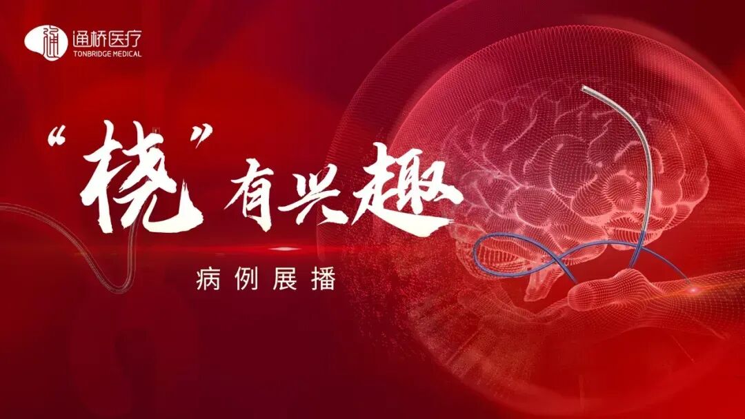 什么西蒙导管【“桡”有兴趣】通桥银蛇®PLUS远端通路导管经桡入路治疗颅内动脉瘤-上海聚慕医疗器械有限公司