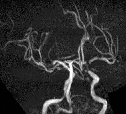 导丝怎么扩【载药时代 球扩天下】NOVA DES®颅内药物洗脱支架在颈内动脉颅内段重度狭窄中的应用体会二例！_https://www.jmylbn.com_新闻资讯_第4张