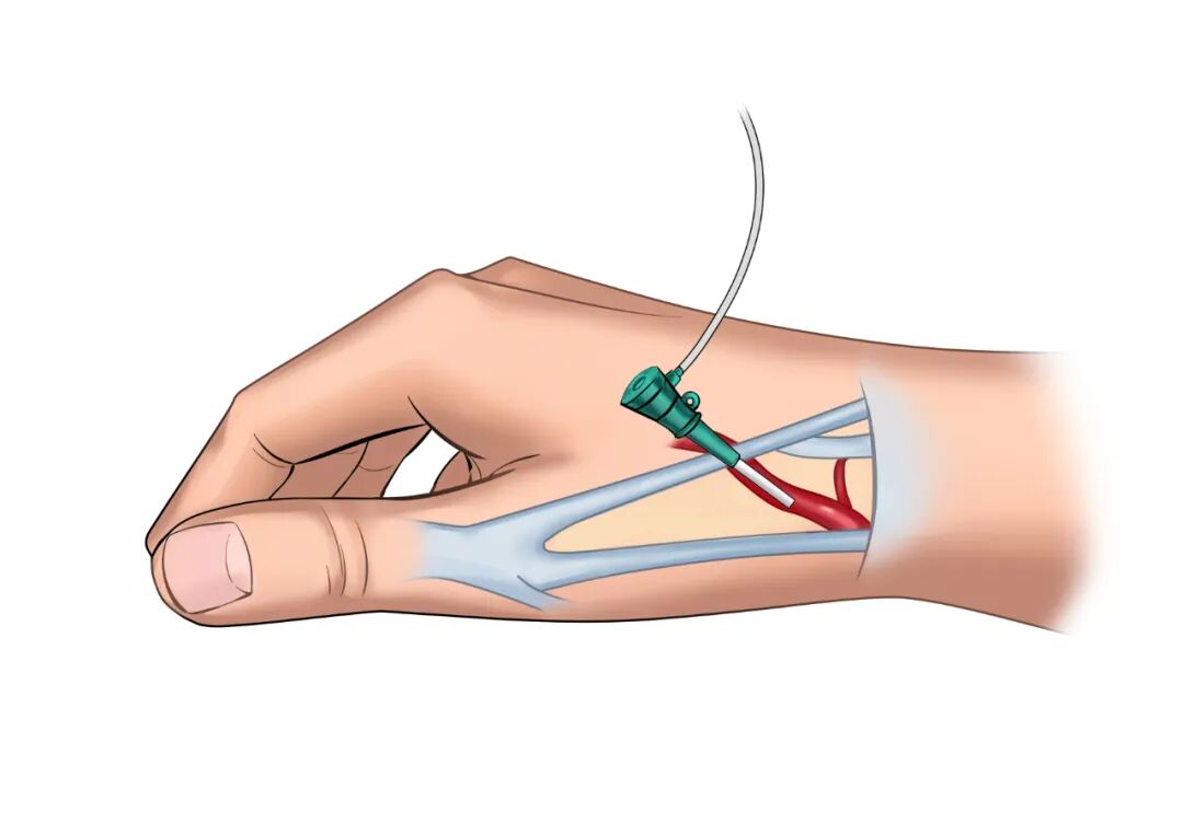 泥鳅导丝怎么用因桡而生 与众不同丨COATS桡动脉专用通路导引系统同轴技术详解_https://www.jmylbn.com_新闻资讯_第8张