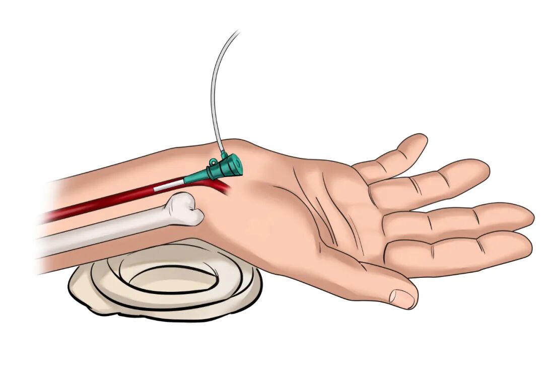 泥鳅导丝怎么用因桡而生 与众不同丨COATS桡动脉专用通路导引系统同轴技术详解_https://www.jmylbn.com_新闻资讯_第7张