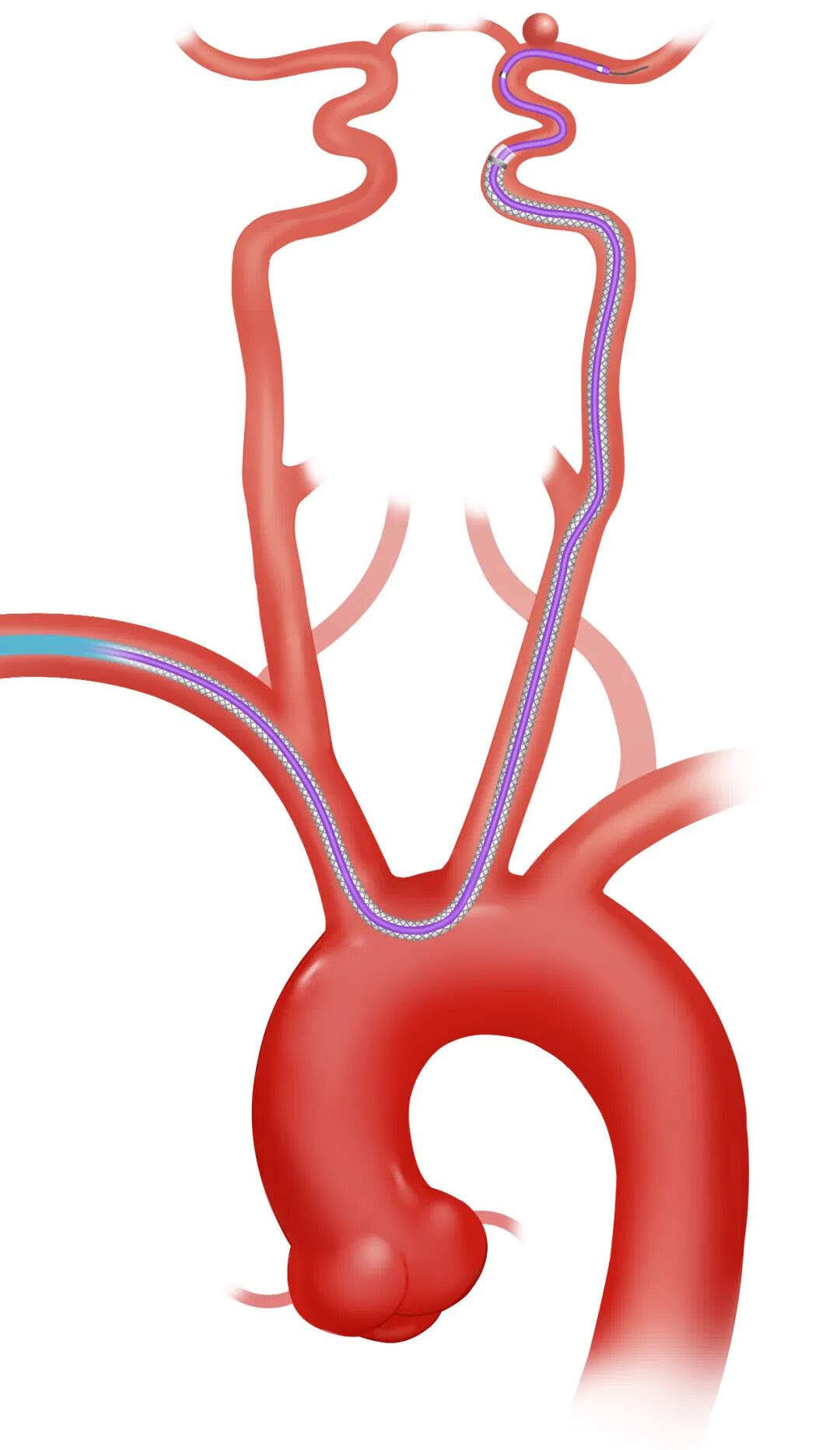 泥鳅导丝怎么用因桡而生 与众不同丨COATS桡动脉专用通路导引系统同轴技术详解_https://www.jmylbn.com_新闻资讯_第17张