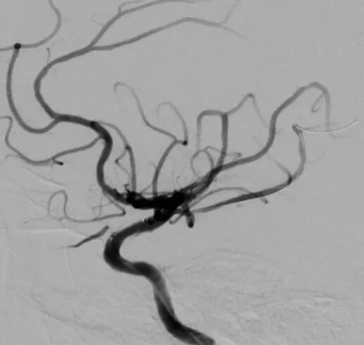 导丝怎么扩【载药时代 球扩天下】NOVA DES®颅内药物洗脱支架在颈内动脉颅内段重度狭窄中的应用体会二例！_https://www.jmylbn.com_新闻资讯_第11张