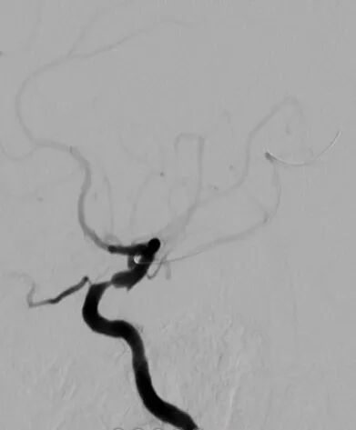 导丝怎么扩【载药时代 球扩天下】NOVA DES®颅内药物洗脱支架在颈内动脉颅内段重度狭窄中的应用体会二例！_https://www.jmylbn.com_新闻资讯_第7张