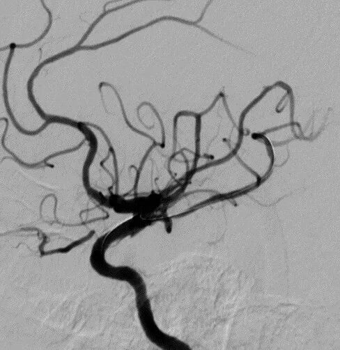 导丝怎么扩【载药时代 球扩天下】NOVA DES®颅内药物洗脱支架在颈内动脉颅内段重度狭窄中的应用体会二例！_https://www.jmylbn.com_新闻资讯_第13张