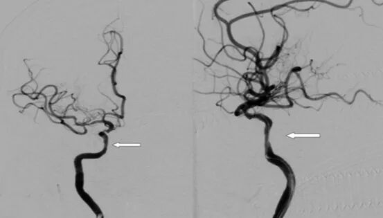 导丝怎么扩【载药时代 球扩天下】NOVA DES®颅内药物洗脱支架在颈内动脉颅内段重度狭窄中的应用体会二例！_https://www.jmylbn.com_新闻资讯_第30张