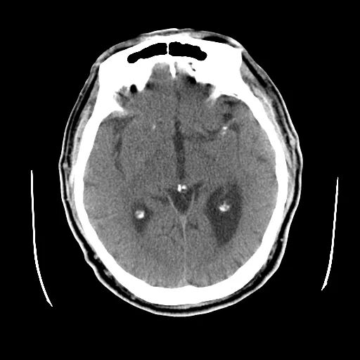 什么叫桡鞘【例久弥新】寻道于桡——瑞康通5.5F Introsky X导管鞘经桡入路治疗颈动脉重度狭窄一例_https://www.jmylbn.com_新闻资讯_第2张