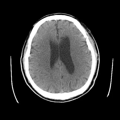 什么叫桡鞘【例久弥新】寻道于桡——瑞康通5.5F Introsky X导管鞘经桡入路治疗颈动脉重度狭窄一例_https://www.jmylbn.com_新闻资讯_第5张