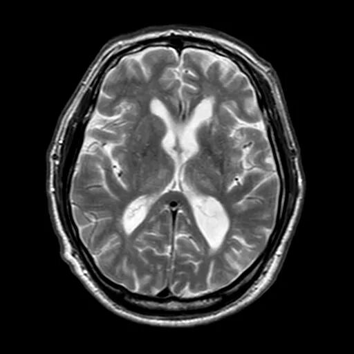 什么叫桡鞘【例久弥新】寻道于桡——瑞康通5.5F Introsky X导管鞘经桡入路治疗颈动脉重度狭窄一例_https://www.jmylbn.com_新闻资讯_第11张