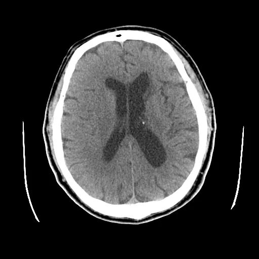 什么叫桡鞘【例久弥新】寻道于桡——瑞康通5.5F Introsky X导管鞘经桡入路治疗颈动脉重度狭窄一例_https://www.jmylbn.com_新闻资讯_第4张