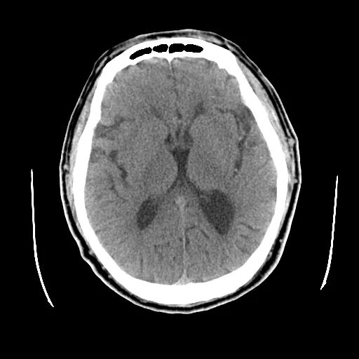 什么叫桡鞘【例久弥新】寻道于桡——瑞康通5.5F Introsky X导管鞘经桡入路治疗颈动脉重度狭窄一例_https://www.jmylbn.com_新闻资讯_第3张
