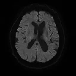 什么叫桡鞘【例久弥新】寻道于桡——瑞康通5.5F Introsky X导管鞘经桡入路治疗颈动脉重度狭窄一例_https://www.jmylbn.com_新闻资讯_第9张