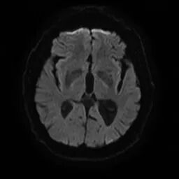 什么叫桡鞘【例久弥新】寻道于桡——瑞康通5.5F Introsky X导管鞘经桡入路治疗颈动脉重度狭窄一例_https://www.jmylbn.com_新闻资讯_第7张