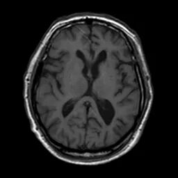 什么叫桡鞘【例久弥新】寻道于桡——瑞康通5.5F Introsky X导管鞘经桡入路治疗颈动脉重度狭窄一例_https://www.jmylbn.com_新闻资讯_第10张