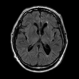 什么叫桡鞘【例久弥新】寻道于桡——瑞康通5.5F Introsky X导管鞘经桡入路治疗颈动脉重度狭窄一例_https://www.jmylbn.com_新闻资讯_第12张