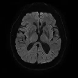 什么叫桡鞘【例久弥新】寻道于桡——瑞康通5.5F Introsky X导管鞘经桡入路治疗颈动脉重度狭窄一例_https://www.jmylbn.com_新闻资讯_第8张