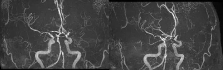 导丝怎么扩【载药时代 球扩天下】NOVA DES®颅内药物洗脱支架在颅内富穿支区域使用体会二例！_https://www.jmylbn.com_新闻资讯_第6张