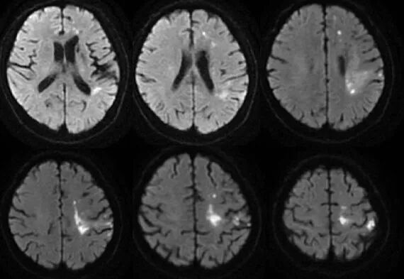导丝怎么扩【载药时代 球扩天下】NOVA DES®颅内药物洗脱支架在颅内富穿支区域使用体会二例！_https://www.jmylbn.com_新闻资讯_第11张