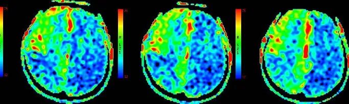 导丝怎么扩【载药时代 球扩天下】NOVA DES®颅内药物洗脱支架在颅内富穿支区域使用体会二例！_https://www.jmylbn.com_新闻资讯_第9张