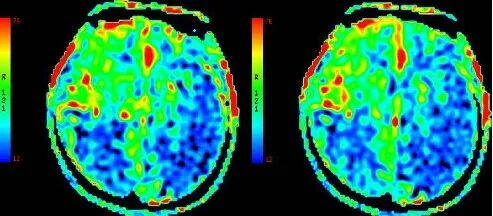 导丝怎么扩【载药时代 球扩天下】NOVA DES®颅内药物洗脱支架在颅内富穿支区域使用体会二例！_https://www.jmylbn.com_新闻资讯_第8张