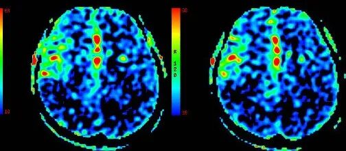 导丝怎么扩【载药时代 球扩天下】NOVA DES®颅内药物洗脱支架在颅内富穿支区域使用体会二例！_https://www.jmylbn.com_新闻资讯_第12张
