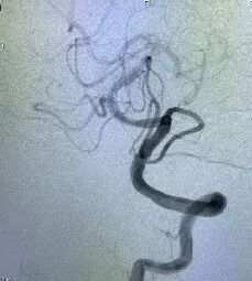 导丝怎么扩【载药时代 球扩天下】NOVA DES®颅内药物洗脱支架在颅内富穿支区域使用体会二例！_https://www.jmylbn.com_新闻资讯_第36张