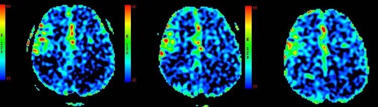 导丝怎么扩【载药时代 球扩天下】NOVA DES®颅内药物洗脱支架在颅内富穿支区域使用体会二例！_https://www.jmylbn.com_新闻资讯_第13张