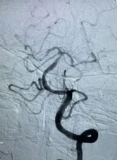 导丝怎么扩【载药时代 球扩天下】NOVA DES®颅内药物洗脱支架在颅内富穿支区域使用体会二例！_https://www.jmylbn.com_新闻资讯_第35张