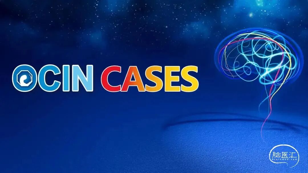 医疗FD是什么【OCIN CASES】教学病例-28：FD结合弹簧圈治疗破裂急性期的血泡样动脉瘤-上海聚慕医疗器械有限公司