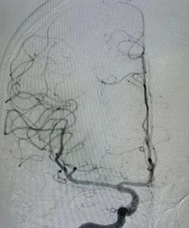 导丝怎么扩【载药时代 球扩天下】NOVA DES®颅内药物洗脱支架在大脑中动脉重度狭窄的应用二例！_https://www.jmylbn.com_新闻资讯_第30张