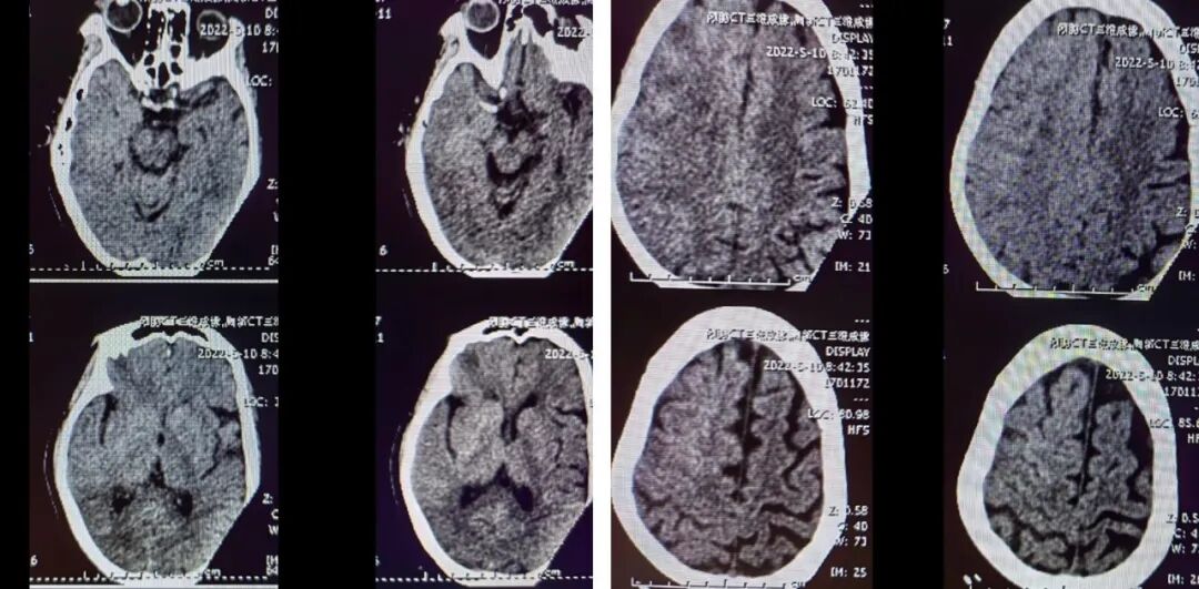 导丝怎么扩【载药时代 球扩天下】NOVA DES®颅内药物洗脱支架在大脑中动脉重度狭窄的应用二例！_https://www.jmylbn.com_新闻资讯_第17张