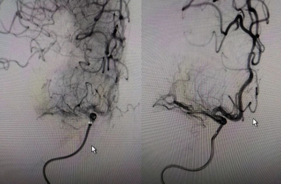 导丝怎么扩【载药时代 球扩天下】NOVA DES®颅内药物洗脱支架在大脑中动脉重度狭窄的应用二例！_https://www.jmylbn.com_新闻资讯_第14张